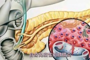 坏死性胰腺炎是什么引起的,坏死性胰腺炎