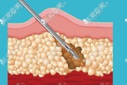 吸脂减肥的多少钱,吸脂价格减肥