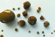 胆结石吃什么可以化掉结石,胆结石吃什么可以化掉结石中药
