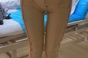 减肥吸脂减肥吸脂医院吸脂减肥收费