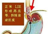 胃食管反流病的临床表现,胃食管反流病