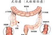 大肠癌的早期能治愈吗大肠癌的早期症状