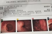 贲门炎贲门炎最怕的三种食物