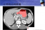 胃穿孔十个漏九个死消化道穿孔