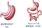 切胃手术减肥的危害,切胃手术减肥