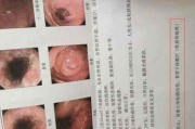糜烂性胃炎,治疗糜烂性胃炎特效药