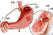 有慢性胃炎，吃什么养胃？