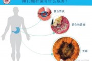 家里一个人查出幽门螺旋杆菌感染幽门螺杆菌有什么症状