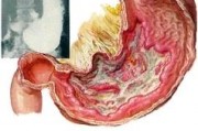 胃炎与胃溃疡有什么区别？