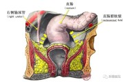 直肠癌能治好吗,直肠