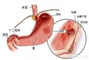 胃溃疡和十二指肠溃疡的区别在哪，会癌变吗？
