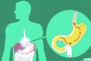 烧心治疗烧心最有效的方法