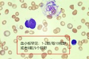血小板分布宽度187,血小板分布宽度