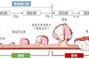 肠癌早期症状,警惕肠癌早期四大征兆 肠癌早期症状,警惕肠癌早期四大征兆
