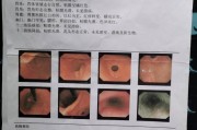慢性非萎缩性胃炎是什么意思慢性非萎缩性胃炎的症状及治疗