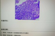 浅表萎缩性胃炎hp阳性浅表萎缩性胃炎 浅表萎缩性胃炎hp阳性浅表萎缩性胃炎