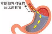 反流性食管炎,反流性食管炎b级严重吗