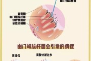 关于幽门螺旋杆菌阳性是什么病会传染吗的信息