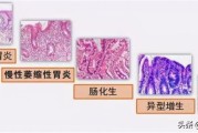 慢性浅表性胃炎会自愈吗,浅表性胃炎的症状