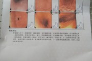 物理方法控制胆汁反流性胃炎 物理方法控制胆汁反流性胃炎
