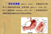 十二指肠溃疡的治疗药物十二指肠溃疡的治疗
