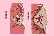 咽喉癌的早期症状表现感觉脖子下边食道里堵着东西