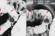 小肠癌小肠癌可怕吗