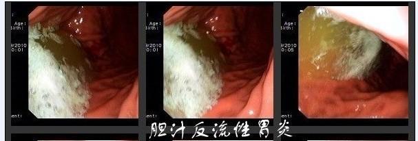 胃炎的症状表现有那些<strong>胃炎</strong>？