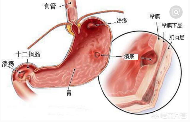 胃溃疡吃什么比较好<strong>胃溃疡</strong>？