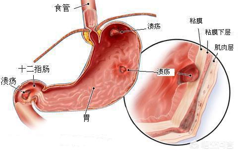 胃溃疡和胃癌的区别是什么<strong>胃溃疡</strong>？