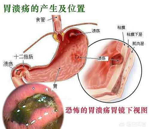 什么是胃溃疡<strong>胃溃疡</strong>？