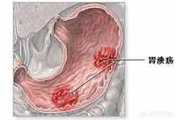 什么是胃溃疡<strong>胃溃疡</strong>？
