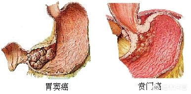 胃溃疡和胃癌的区别是什么<strong>胃溃疡</strong>？