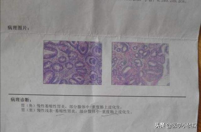 如何判断自己的胃病是否严重<strong>胃炎</strong>？
