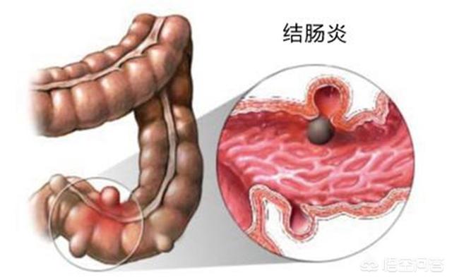 结肠炎与普通肠炎有什么区别<strong>肠炎</strong>？