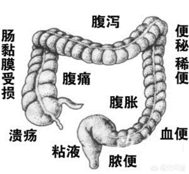 结肠炎与普通肠炎有什么区别<strong>肠炎</strong>？