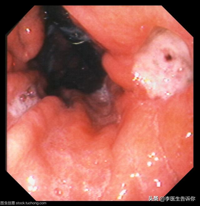 胃溃疡是萎缩性胃炎吗<strong>胃溃疡</strong>？容易癌变吗？