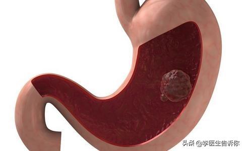 胃溃疡是萎缩性胃炎吗<strong>胃溃疡</strong>？容易癌变吗？