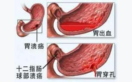 胃溃疡的最全面科普<strong>胃溃疡</strong>，看完你自己都会治疗了