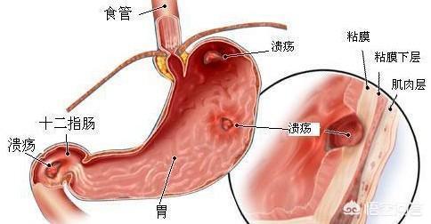 胃溃疡会和口腔溃疡一样<strong>胃溃疡</strong>，慢慢会好的吗？