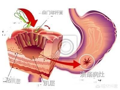 胃溃疡和胃糜烂有什么区别<strong>胃溃疡</strong>？