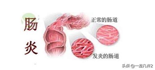 肠炎恶化都有哪些表现<strong>肠炎</strong>？