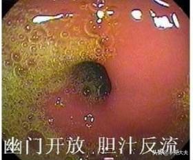 如果一个人患有由胆汁反流造成的胃炎<strong>胃炎</strong>，你觉得吃什么药好？