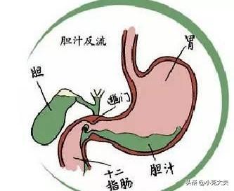 如果一个人患有由胆汁反流造成的胃炎<strong>胃炎</strong>，你觉得吃什么药好？