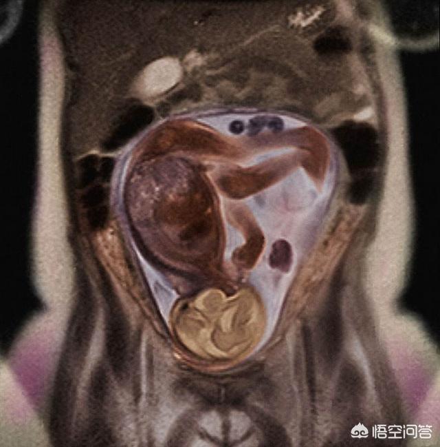 怀孕之后妈妈的内脏被挤到哪里去了<strong>肠道</strong>，会不会变小啊？