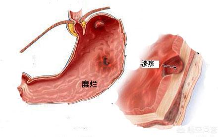 胃溃疡和胃糜烂哪个严重<strong>胃溃疡</strong>？