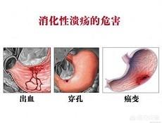 胃溃疡与十二指肠溃疡在临床表现上有哪些异同<strong>胃溃疡</strong>？