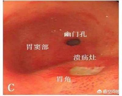 胃溃疡一喝水就会疼、反胃<strong>胃溃疡</strong>，怎么回事？