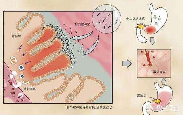 胃溃疡喜欢“缠上”这3类人<strong>胃溃疡</strong>，是指哪三类人？