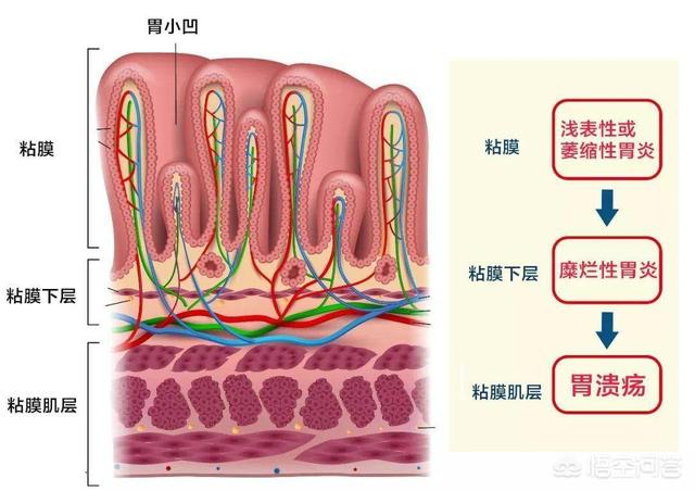 胃溃疡喜欢“缠上”这3类人<strong>胃溃疡</strong>，是指哪三类人？